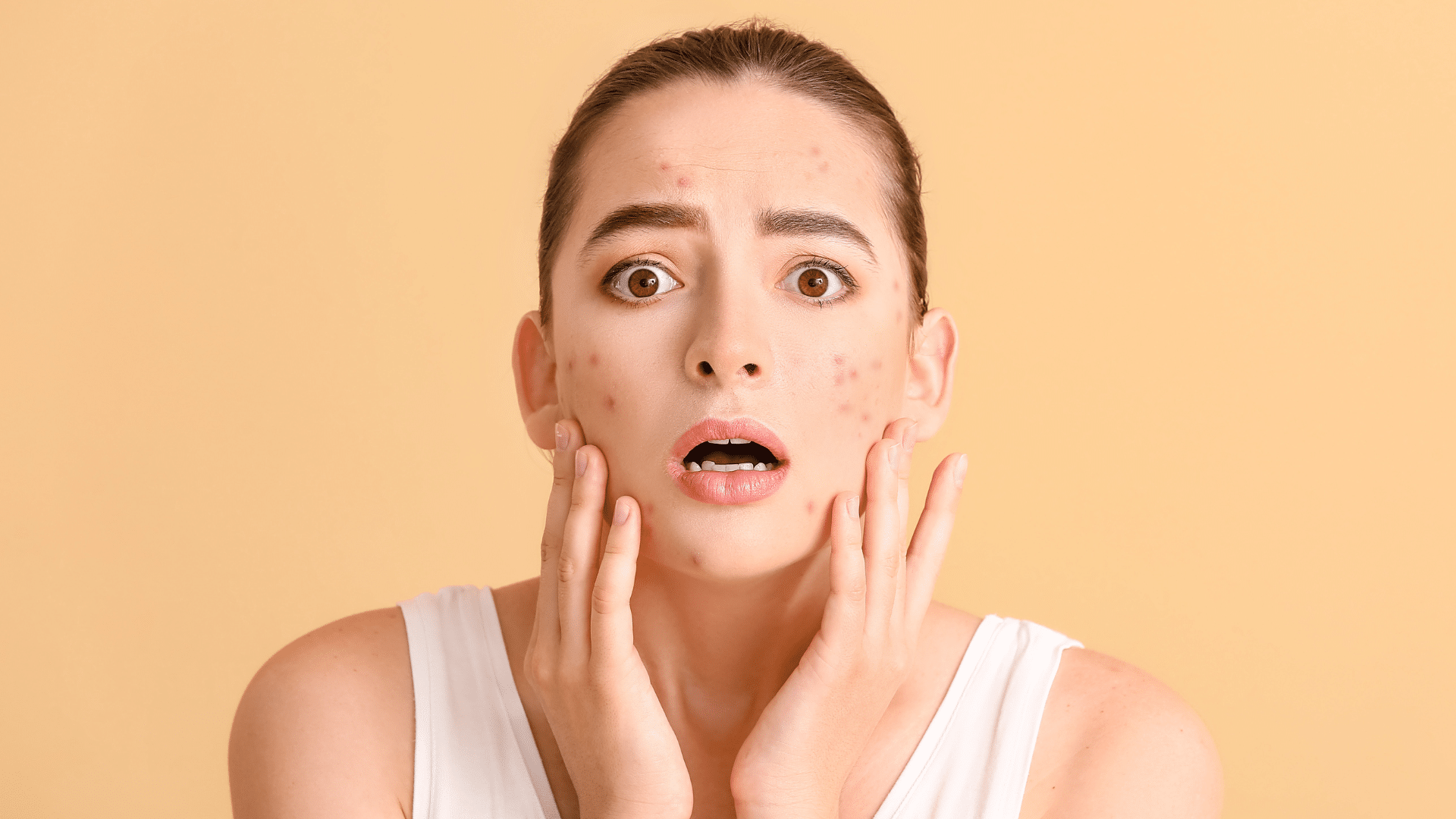 Acné post-pilule : comment retrouver une peau nette