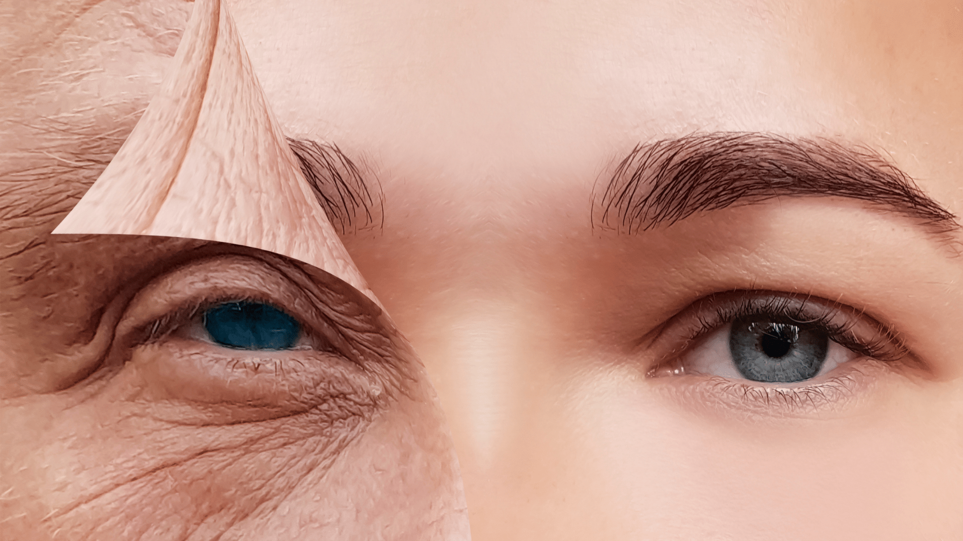 radiofréquence visage, résultats radiofréquence, anti-âge sans chirurgie