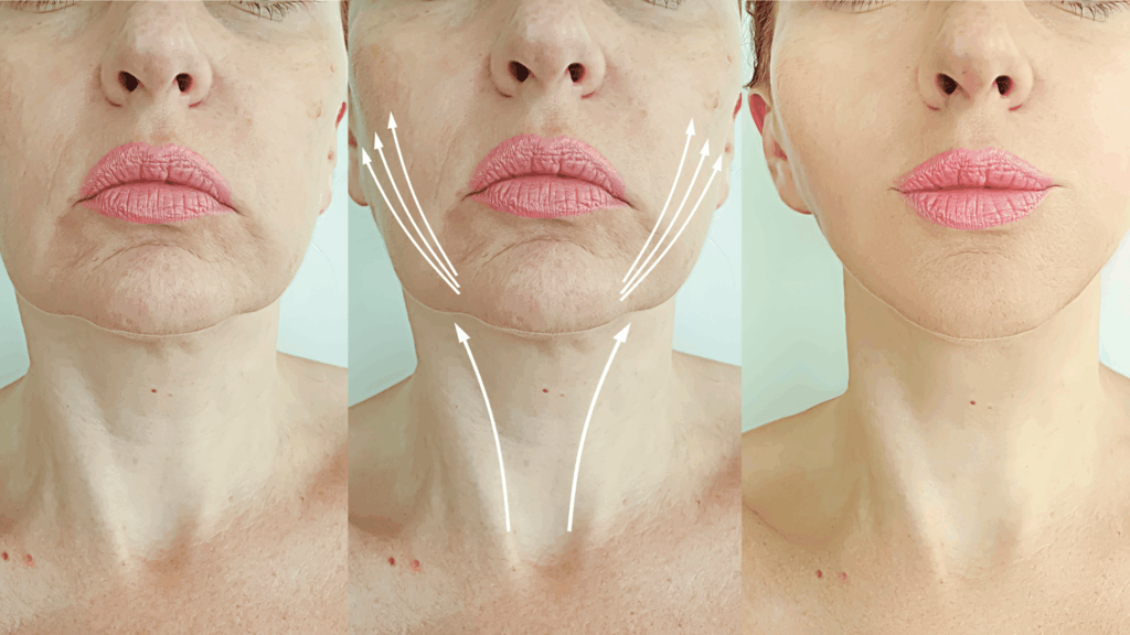 radiofréquence visage, résultats radiofréquence, anti-âge sans chirurgie