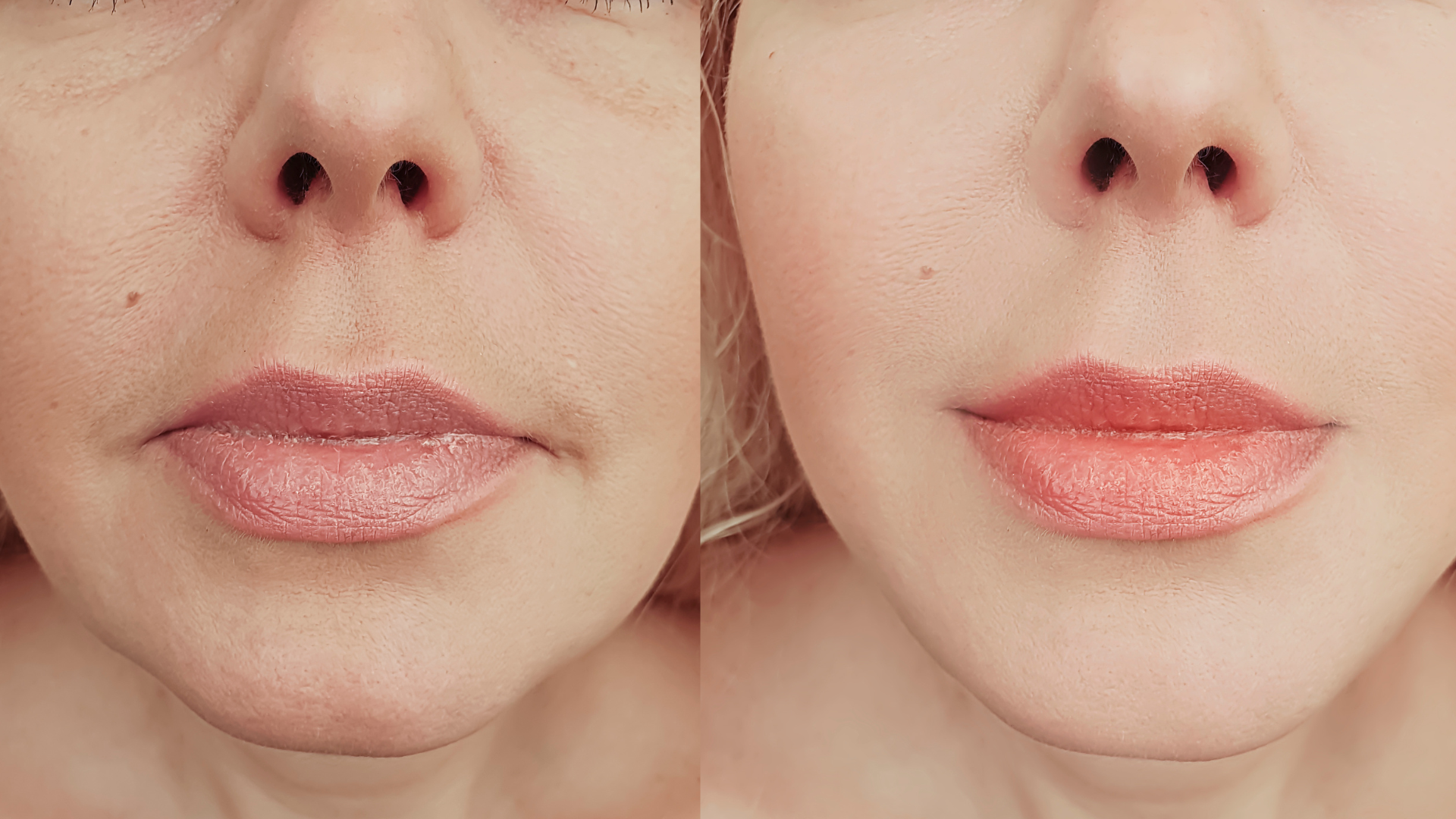 - mésothérapie à Bruxelles - mésothérapie - soins anti-âge bruxelles