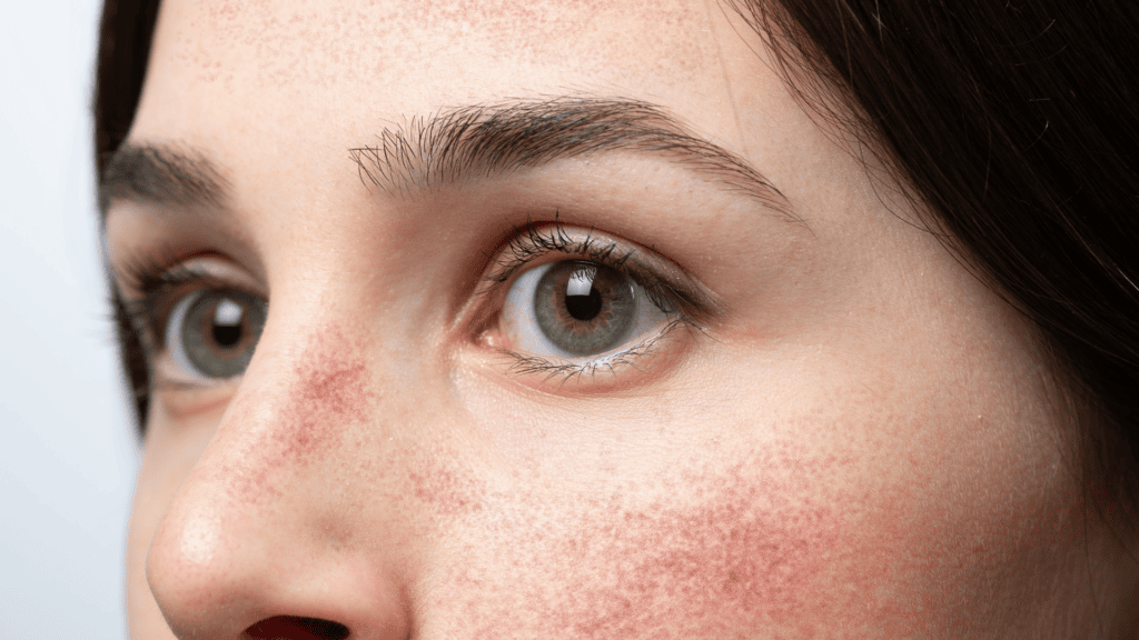 Traitement rougeurs visage